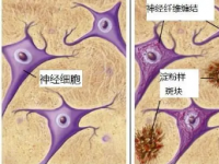 研究将阿尔茨海默病的性别差异与X连锁酶联系起来